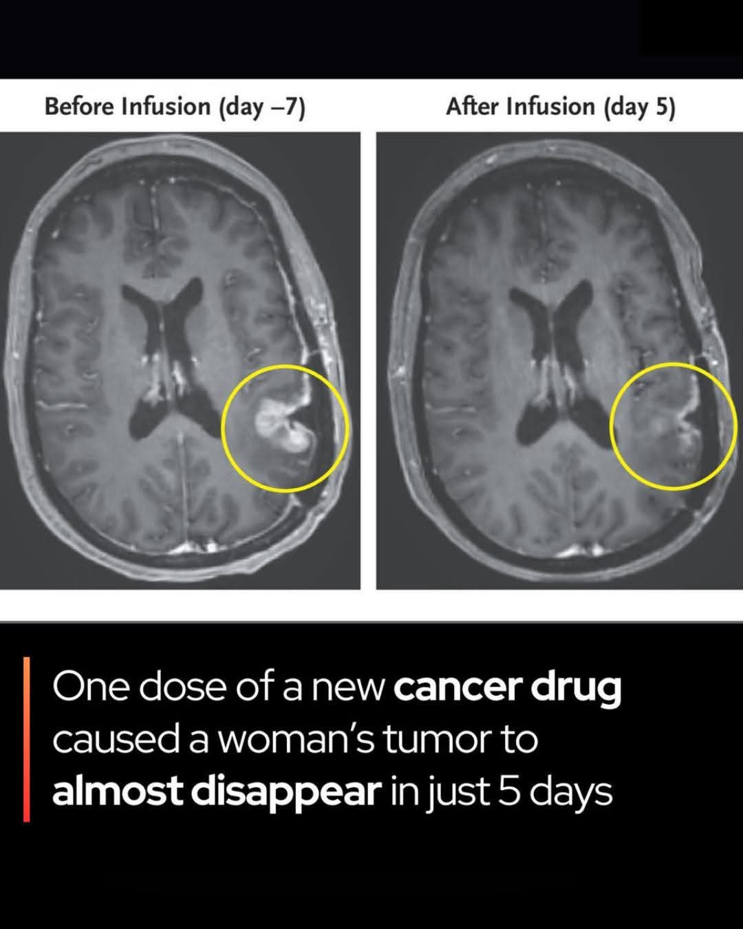 🎗 A brain tumor nearly vanished in just 5 days after one dose of a break...
